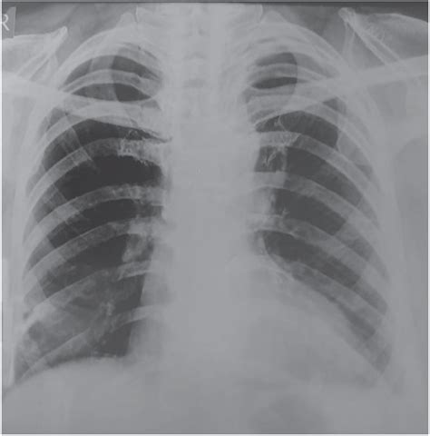Chest X‐ray Posteroanterior View At 6 Months After Pleurodesis