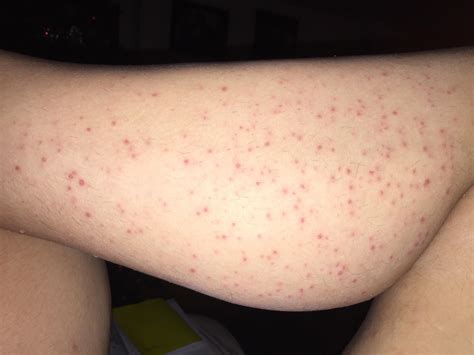 Red Bumps Appeared On Legs A Week After Waxing They Wont Go Away And