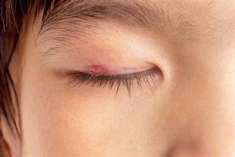 Eyelid Bump Types Causes And Treatment