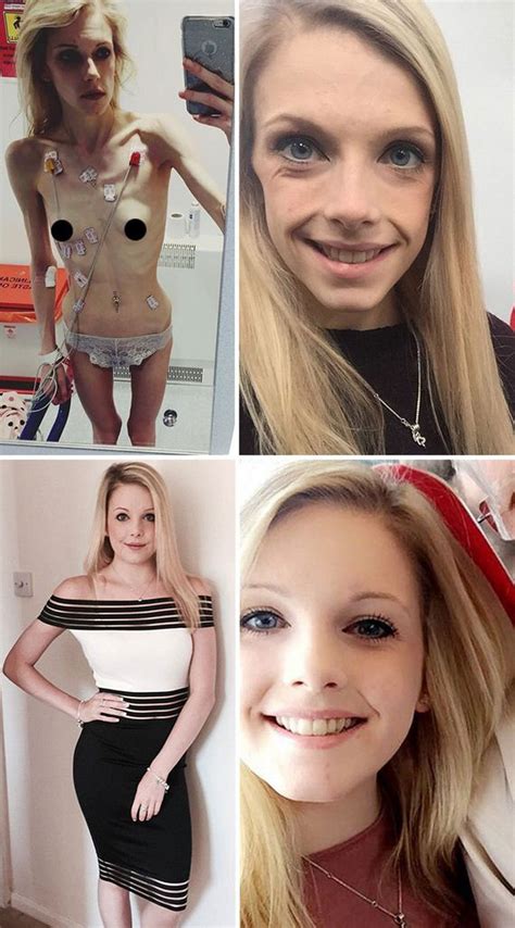 Before And After Photos Of People Who Defeated Anorexia Barnorama
