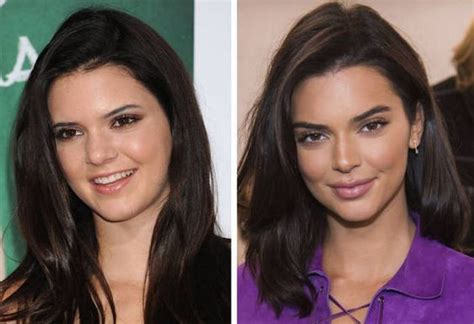 Kendall Jenner Before And After Celebrity Plastic Surgery Plastic