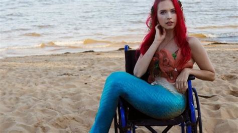 Meet A Real Life Mermaid With A Rare Disease