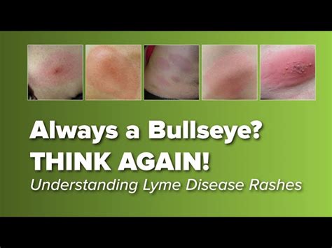 Anreiz Diktator Ehemalige Lyme Disease Ring Rash Psychologisch Theater
