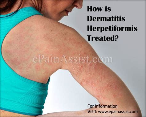 Dermatitis Herpetiformis Dermatitis Herpetiformis Dermatitis Rash