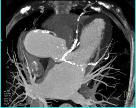 Extensive Coronary Artery Calcification Cardiac Case Studies Ctisus