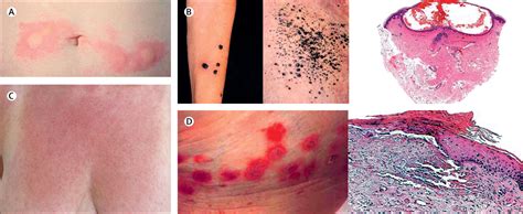 Heparin Induced Skin Lesions The Lancet