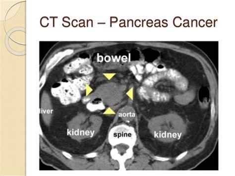 Abdominal Ct Scan Pancreatic Cancer