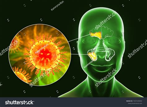Sinusite Virale Inflammation Des Cavités Paranasales Illustration