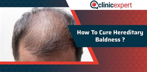 Hereditary Baldness Causes Symptoms And Treatment Justinboey