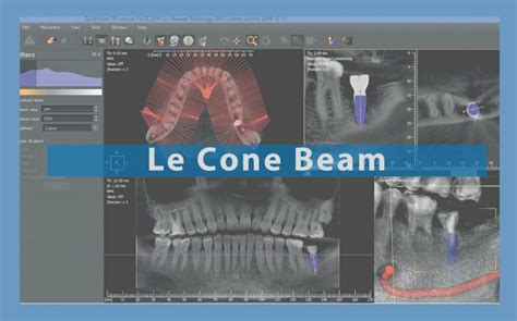 Cone Beam Le Gold Standard De La Chirurgie Dentaire