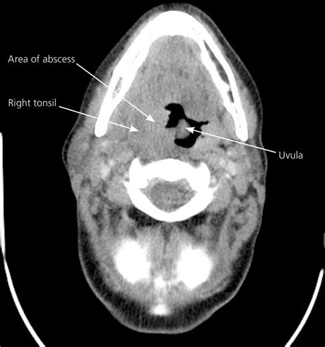 Peritonsillar Abscess X Ray