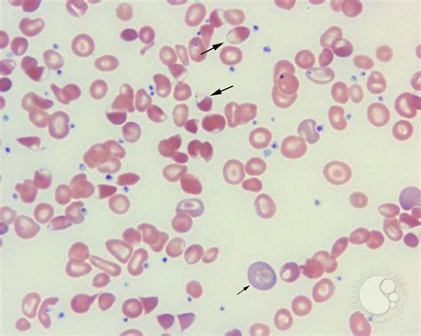 Blister Cell 1