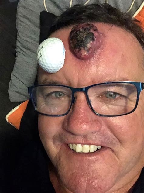 Mans Tiny Pimple Turned Into Cancerous Lump The Size Of A Golf Ball