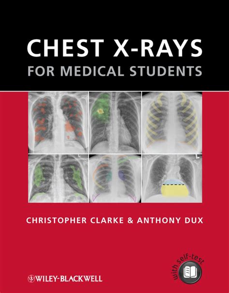 Chest X Rays For Medical Students Ebook Medical Students Medical