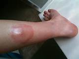 Pictures of Allergic Reaction To Fire Ants
