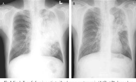 Figure 1 From A Case Of Pulmonary Cryptococcosis In An Immunocompetent