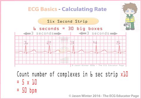 How To Calculate Heart Rate From Irregular Ecg