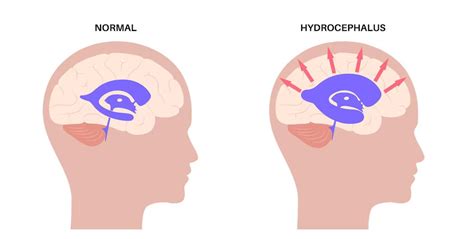 Hydrocephalus Symptoms Causes And Treatment Arihant Neuro