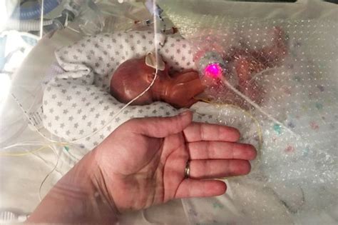 Miracle Baby Born Weighing Just Over 1lb With Translucent Skin And
