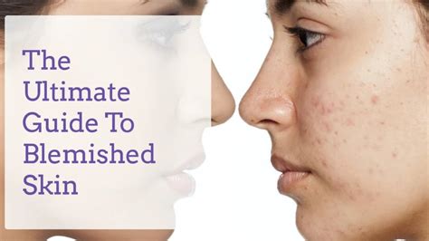 The Ultimate Guide To Blemished Skin Skin Care Top News