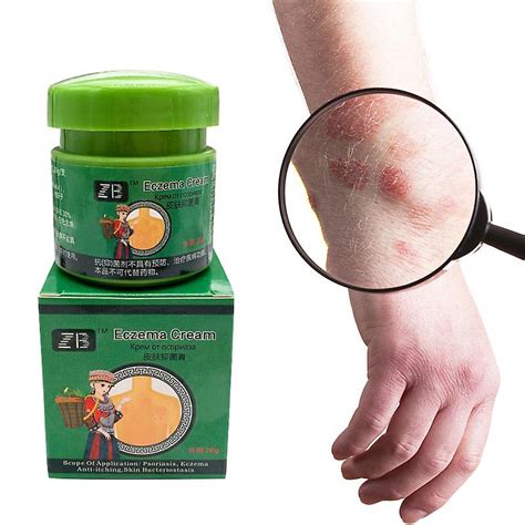 Miao Herbal Psoriasis Cream Anti Itch Antibacterial Creams Relief Eczema Urticaria Ointment