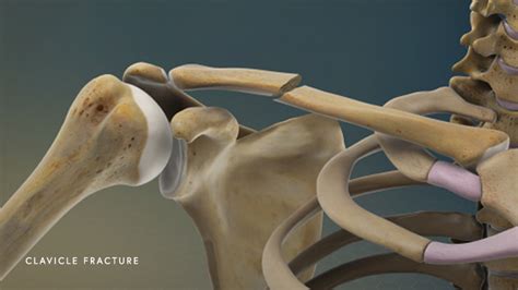Clavicle Fracture Center For Orthopedic Specialists
