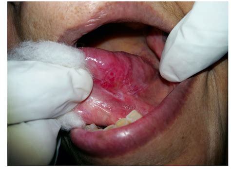 Potentially Malignant Oral Lesions E Dantseva