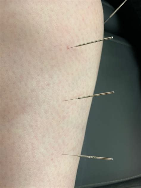 Dry Needling And Your Feet — Footrix Podiatry