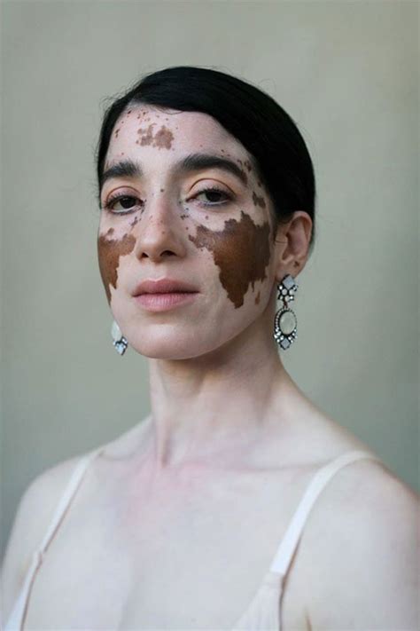 Le Vitiligo Mis En Lumière Par Une Photographe Elle Même Atteinte Lors