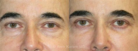 Patient 71700120 Eye Rejuvenation Before And After Photos Carmel