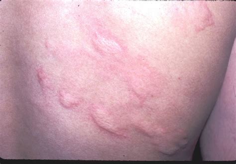 Red Blotchy Rash Pictures Photos
