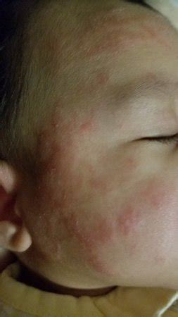 Be sure to note any symptoms that occurred before the rash appeared such as fever, changes in a medical history of asthma, food, seasonal allergies and allergic sinus problems are related to the condition. Rash On Face Due To Food Allergy - Food Ideas