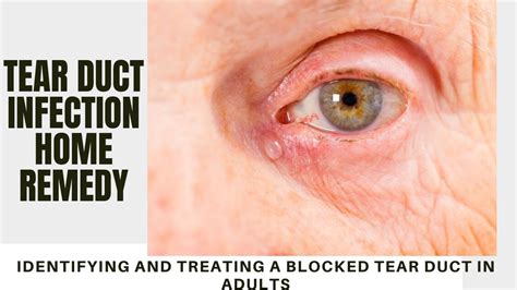 Tear Duct Infection Home Remedy Identifying And Treating A Blocked