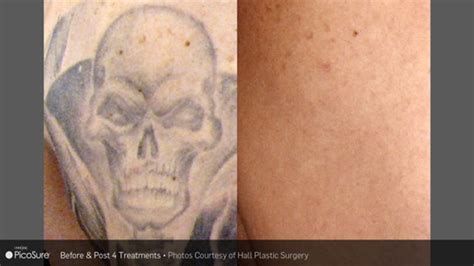 Lasermed skin & vein clinic. Virtually Painless Laser Tattoo Removal | Camp M.D ...