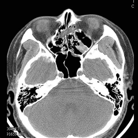 PDF Long Term Retention Of Ethmoid Sinus Foreign Body Manifested As