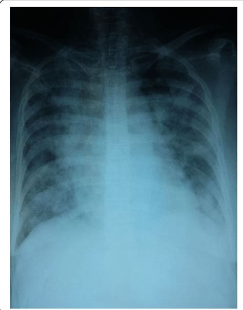 Chest Radiograph Which Was Taken When Our Patient Deteriorated On Day