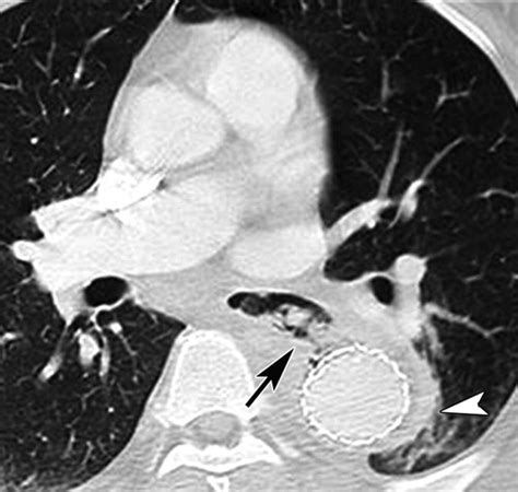 Aortoenteric Fistulas Ct Features And Potential Mimics Radiographics