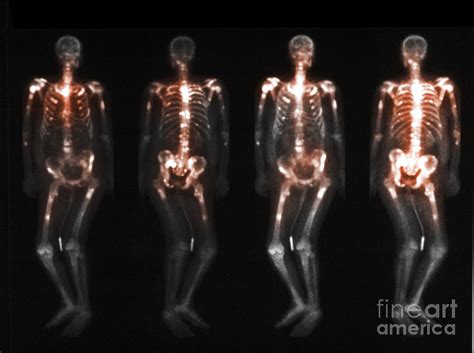 Bone Scan Showing Multiple Metastases Photograph By Scott Camazine Fine Art America