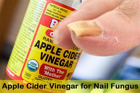 Best Treatment For Toenail Fungus 2017