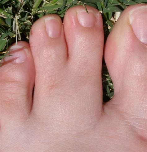 Webbed Toes Causes Symptoms And Treatment