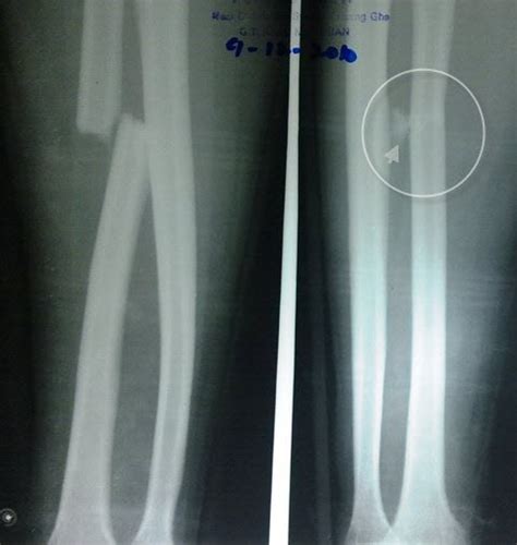 Forearm Injuries Xrays And Photographs Bone And Spine