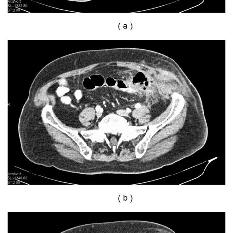 Photograph Of The Abdominal Wall Abscess After Surgical Drainage