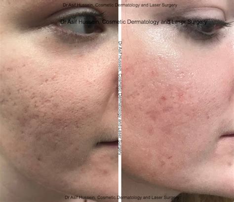 Can Laser Treatments Lighten Acne Scars North York Cosmetic Clinic