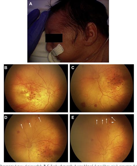 Figure 2 From Expanded Spectrum Of Congenital Ocular Findings In Microcephaly With Presumed Zika