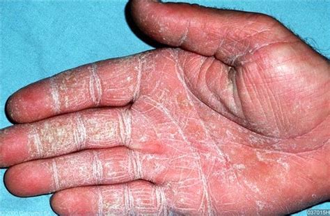 Tinea Manuum Causas Síntomas Y Más Consejo Del Doctor 2022