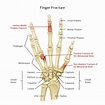 Finger and Hand Fractures - Orchard Health Clinic - Osteopathy ...