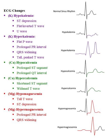 Visual For ECG Changes For Different Electrolyte Imbalances Nursing Babe Studying Nursing
