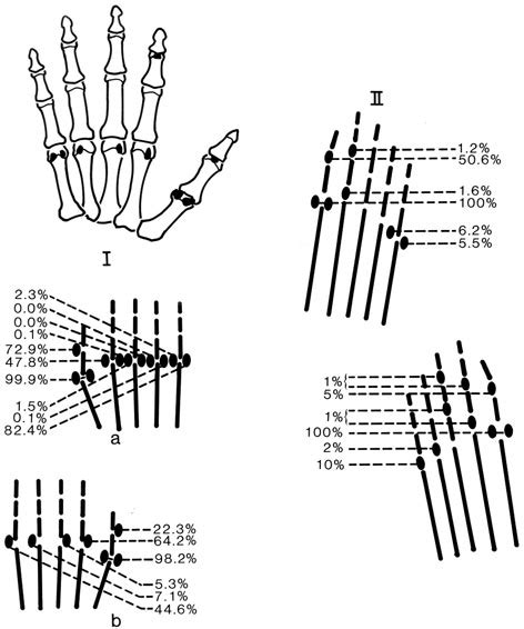 The Sesamoid Bones Are A Variable Structure In The Hand