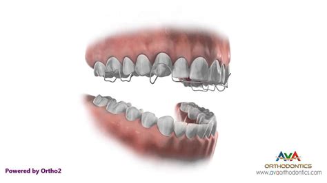 Removable retainers may be better for upper teeth, since the lower teeth may bite on an upper fixed retainer. Hawley Retainer - Instruction and Care - YouTube