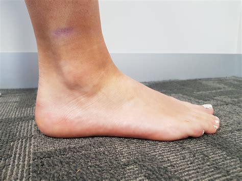Management Of Acute Ankle Sprains — Ballarat Allied Health